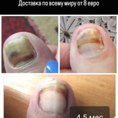 Лечение грибка ногтей и кожи более 2500 отзывов